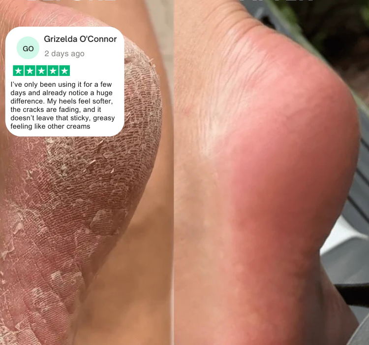 Verta® Anti Cracked Foot Balm