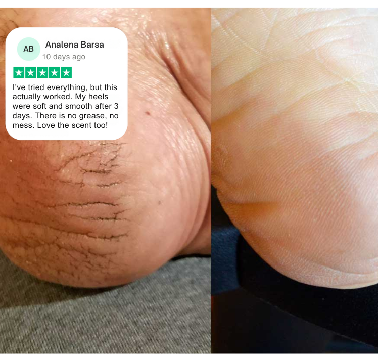 Verta® Anti Cracked Foot Balm