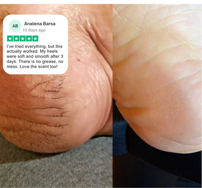 Verta® Anti Cracked Foot Balm